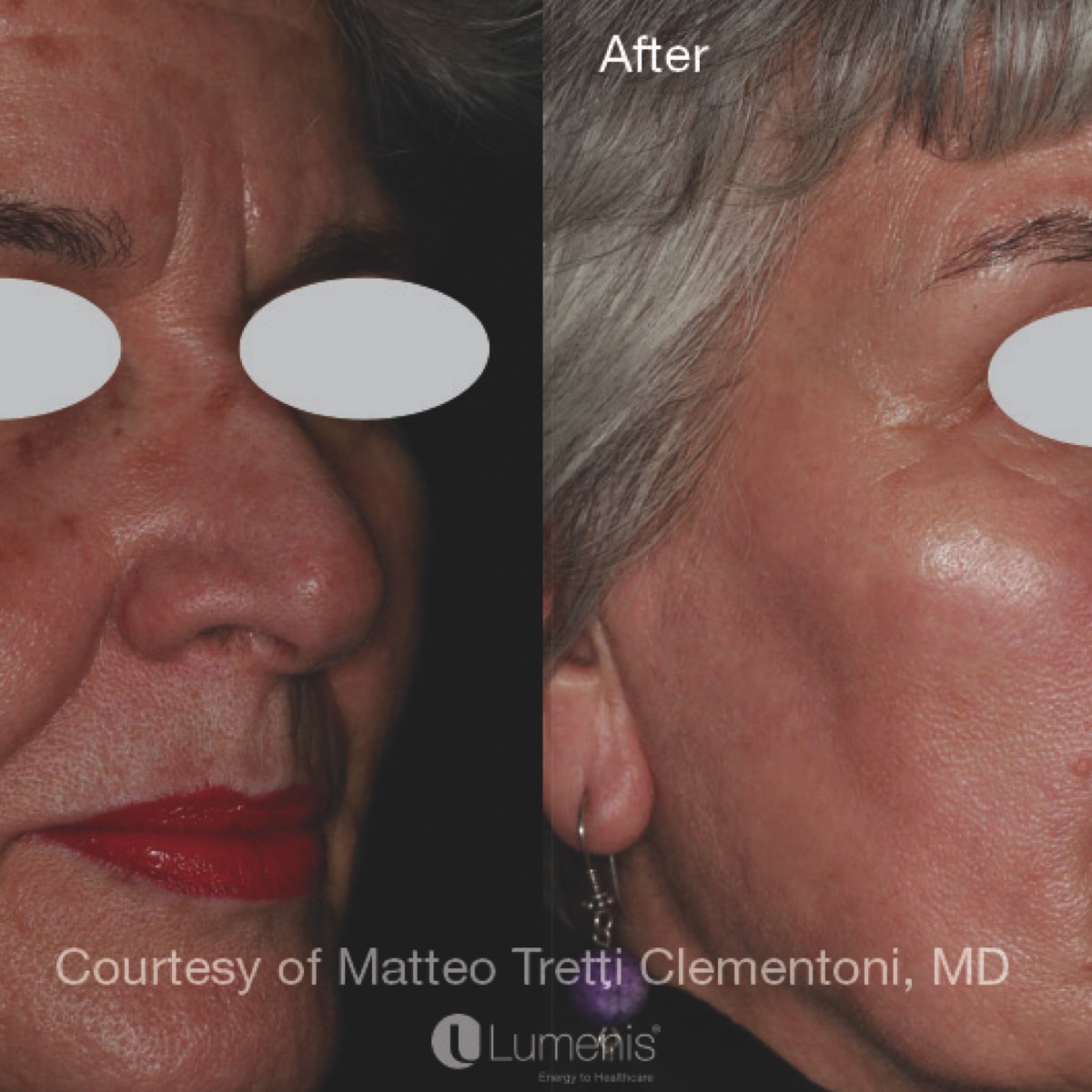 Before and after photo showing how IPL eliminates brown spots.